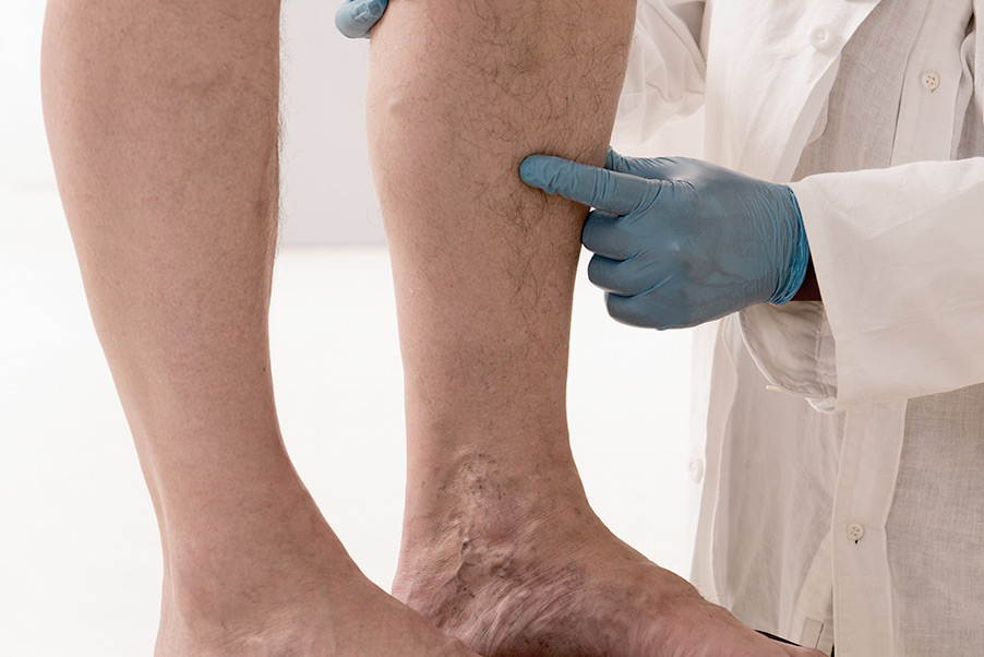 Des veines disgracieuses apparaissent sous la peau : causes et traitements des varices