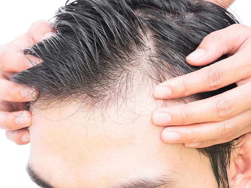La greffe de cheveux : une solution contre la calvitie