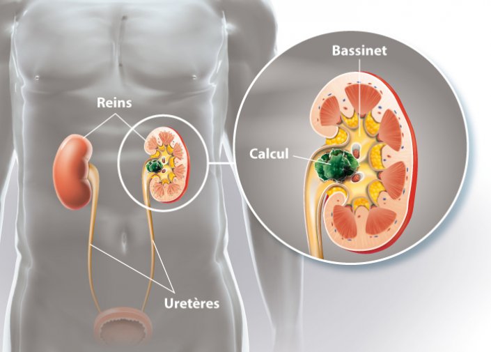 Les calculs rénaux ou les pierres aux reins – Arthus-consulting