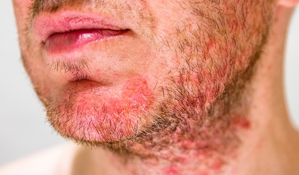 Reconnaitre quelques types de dermatoses